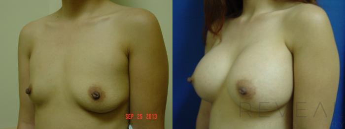 Before & After Breast Augmentation Case 122 View #2 View in San Jose, CA