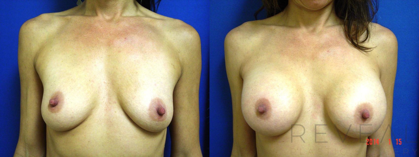 Before & After Breast Augmentation Case 129 View #1 View in San Jose, CA