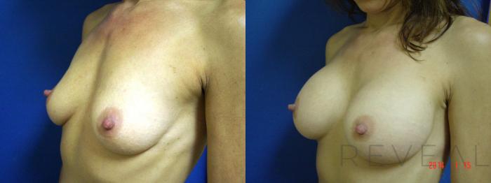 Before & After Breast Augmentation Case 129 View #2 View in San Jose, CA