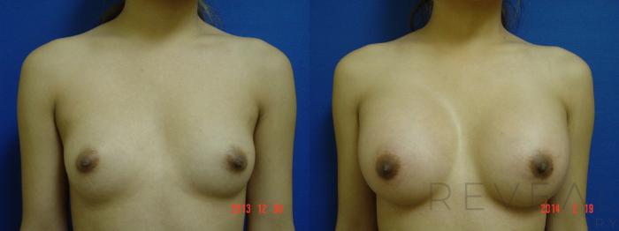 Before & After Breast Augmentation Case 132 View #1 View in San Jose, CA