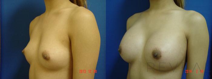 Before & After Breast Augmentation Case 132 View #2 View in San Jose, CA