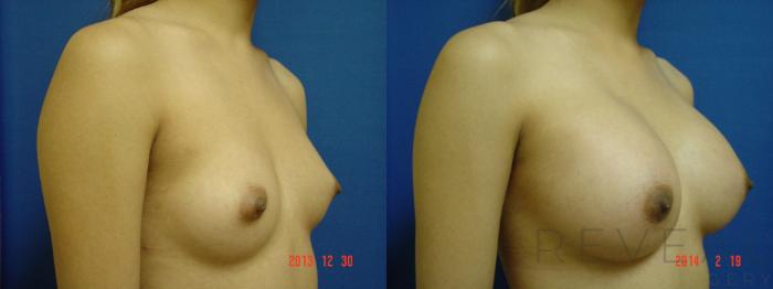 Before & After Breast Augmentation Case 132 View #3 View in San Jose, CA
