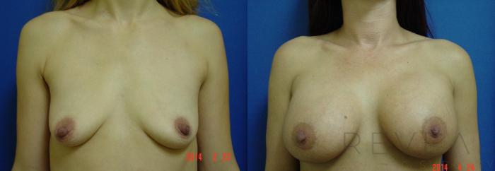 Before & After Breast Augmentation Case 134 View #1 View in San Jose, CA