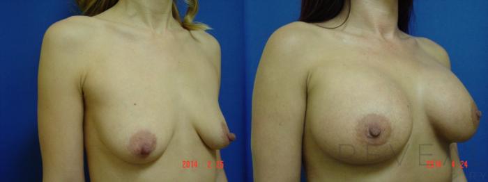Before & After Breast Augmentation Case 134 View #2 View in San Jose, CA
