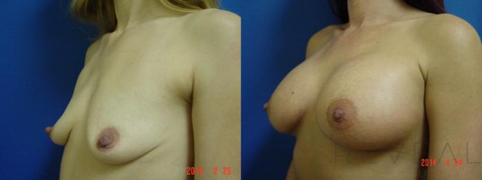 Before & After Breast Augmentation Case 134 View #3 View in San Jose, CA