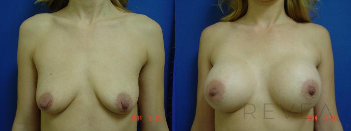 Before & After Breast Augmentation Case 135 View #1 View in San Jose, CA