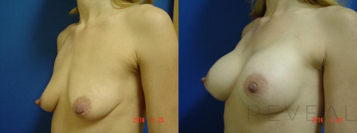 Before & After Breast Augmentation Case 135 View #2 View in San Jose, CA