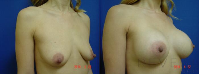 Before & After Breast Augmentation Case 135 View #3 View in San Jose, CA