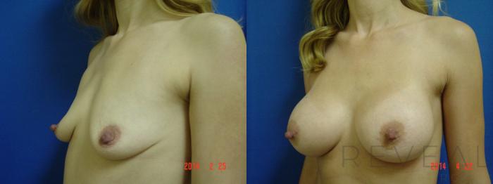 Before & After Breast Augmentation Case 136 View #1 View in San Jose, CA