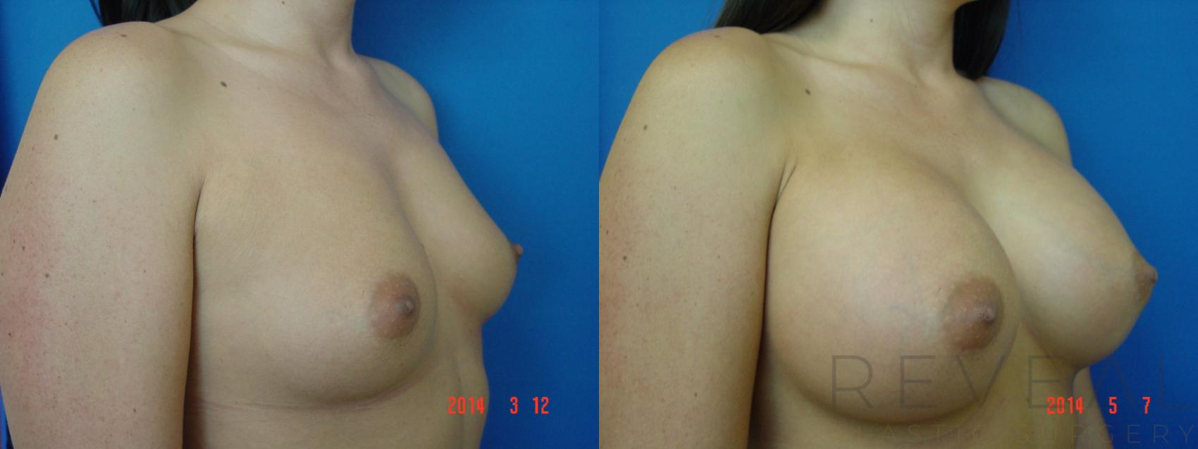 Before & After Breast Augmentation Case 139 View #1 View in San Jose, CA