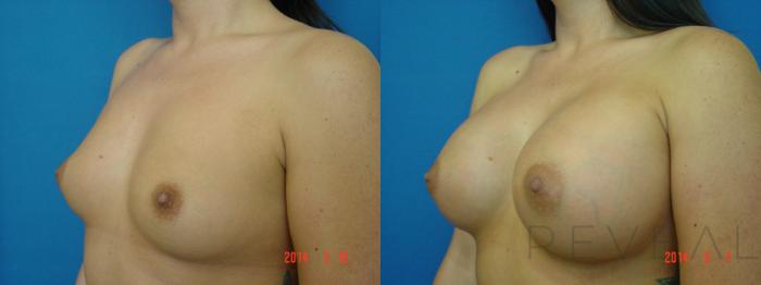 Before & After Breast Augmentation Case 139 View #3 View in San Jose, CA