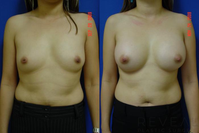 Before & After Breast Augmentation Case 15 View #1 View in San Jose, CA