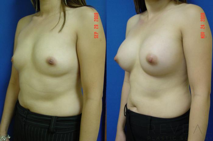 Before & After Breast Augmentation Case 15 View #2 View in San Jose, CA