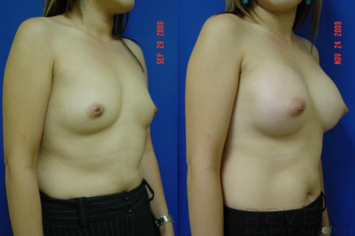 Before & After Breast Augmentation Case 15 View #3 View in San Jose, CA