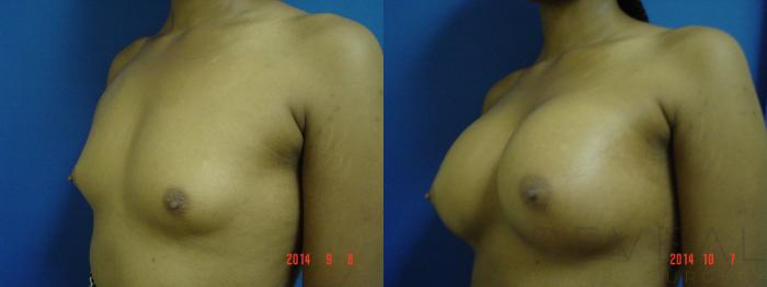 Before & After Breast Augmentation Case 158 View #1 View in San Jose, CA