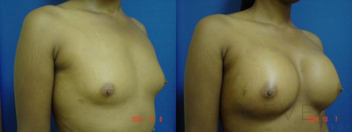 Before & After Breast Augmentation Case 158 View #3 View in San Jose, CA