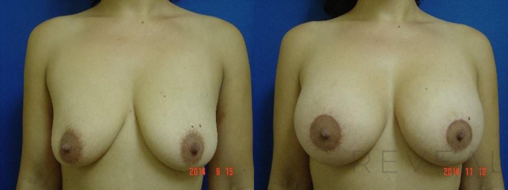 Before & After Breast Lift Case 160 View #1 View in San Jose, CA