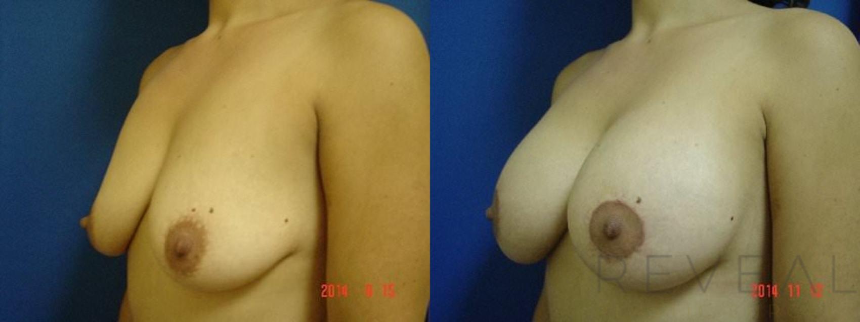 Before & After Breast Lift Case 160 View #2 View in San Jose, CA
