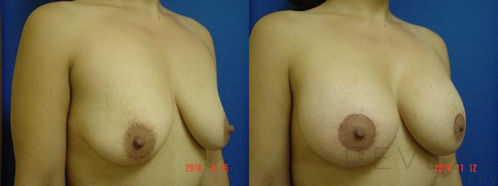 Before & After Breast Lift Case 160 View #3 View in San Jose, CA