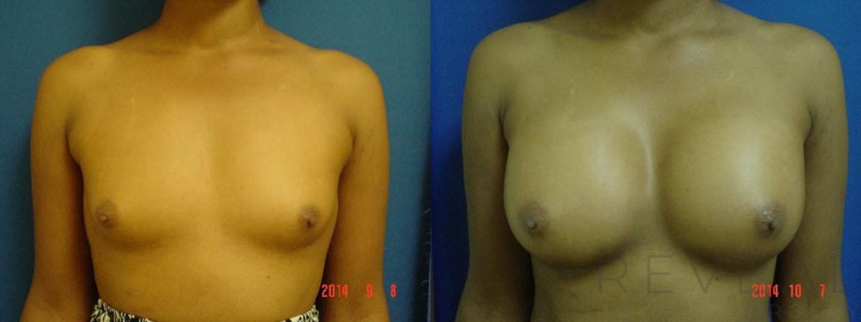 Before & After Breast Augmentation Case 162 View #1 View in San Jose, CA