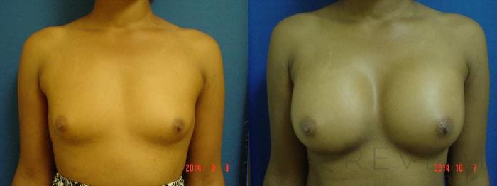 Before & After Breast Augmentation Case 162 View #1 View in San Jose, CA