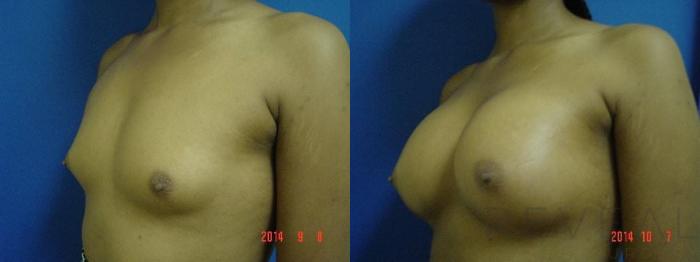 Before & After Breast Augmentation Case 162 View #2 View in San Jose, CA