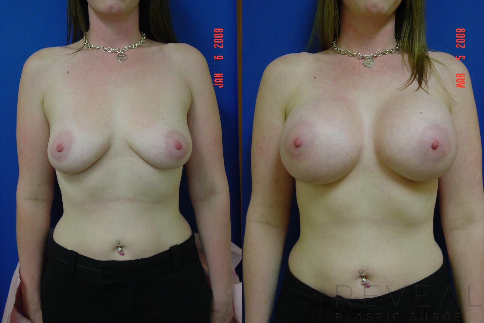 Before & After Breast Augmentation Case 17 View #1 View in San Jose, CA