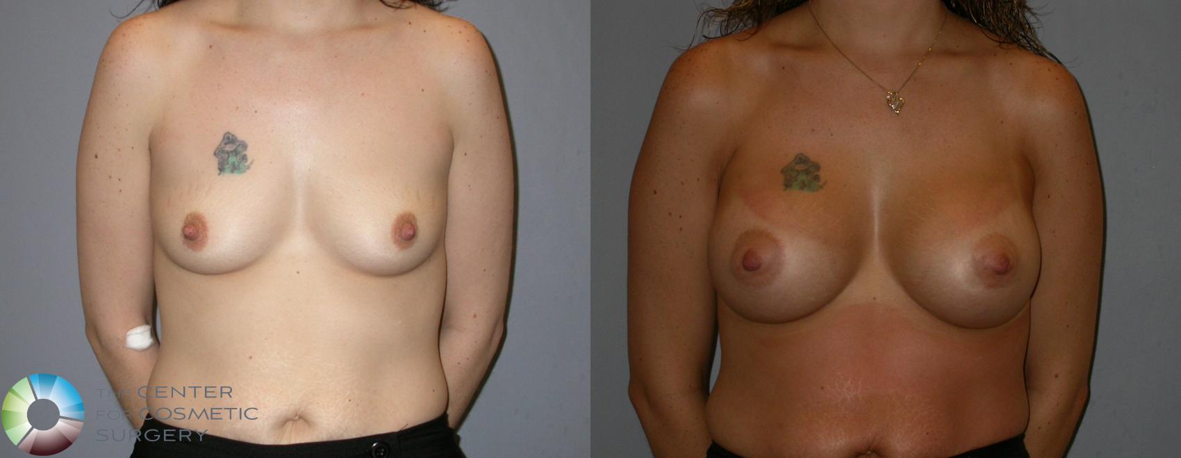 Before & After Breast Augmentation Case 173 View #1 View in San Jose, CA