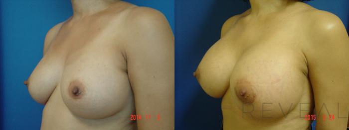 Before & After Breast Augmentation Case 173 View #2 View in San Jose, CA
