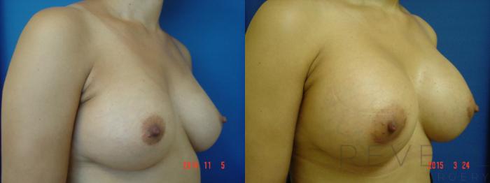 Before & After Breast Augmentation Case 173 View #3 View in San Jose, CA