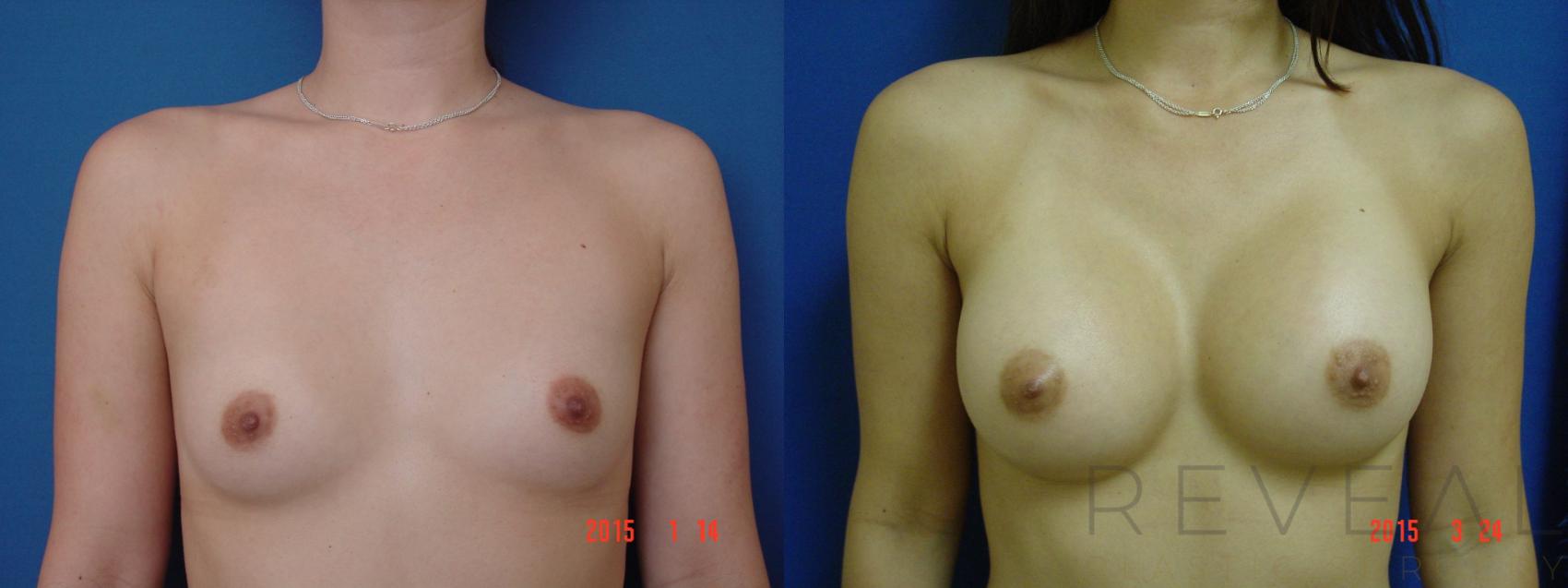 Before & After Breast Augmentation Case 174 View #1 View in San Jose, CA