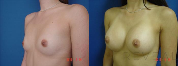 Before & After Breast Augmentation Case 174 View #2 View in San Jose, CA