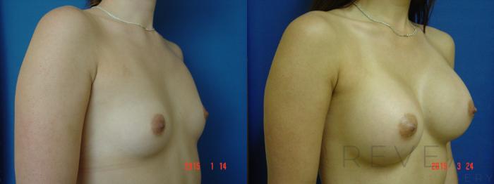 Before & After Breast Augmentation Case 174 View #3 View in San Jose, CA