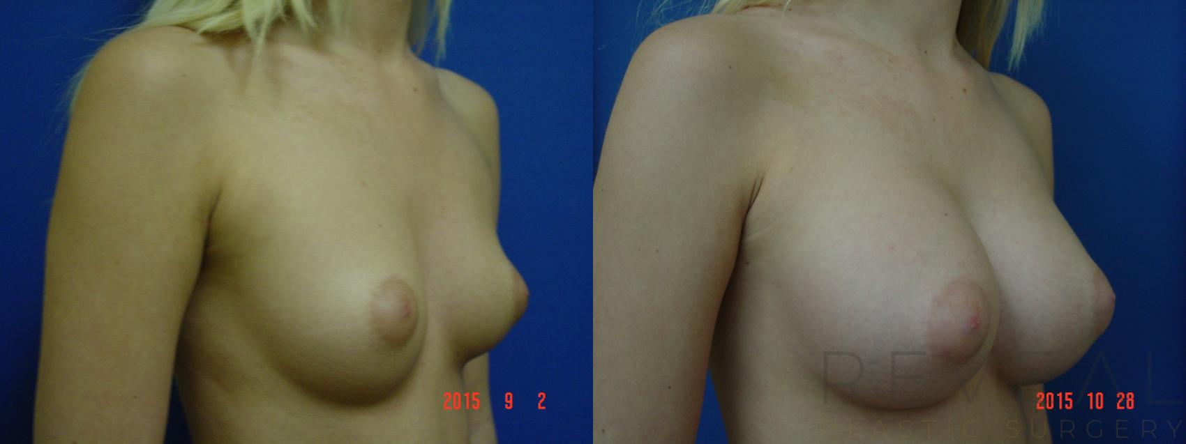 Before & After Breast Augmentation Case 178 View #1 View in San Jose, CA