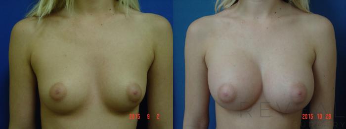 Before & After Breast Augmentation Case 178 View #2 View in San Jose, CA