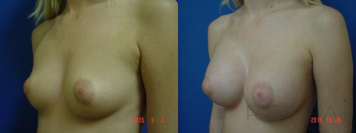 Before & After Breast Augmentation Case 178 View #3 View in San Jose, CA