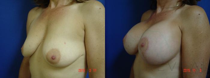 Before & After Breast Augmentation Case 179 View #2 View in San Jose, CA