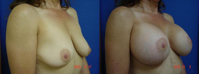 Before & After Breast Augmentation Case 179 View #3 View in San Jose, CA
