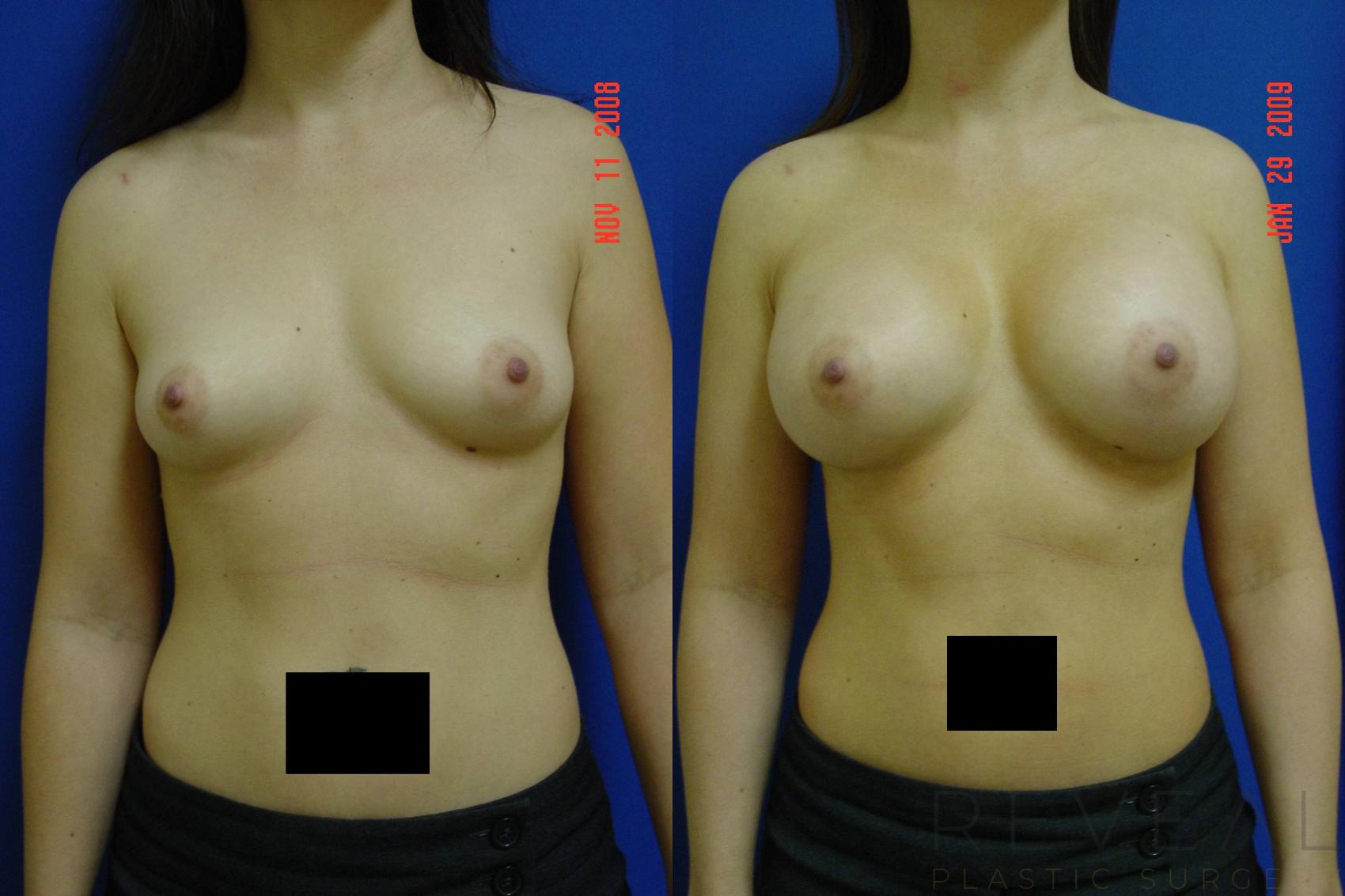 Before & After Breast Augmentation Case 18 View #1 View in San Jose, CA