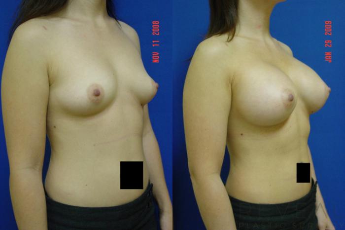 Before & After Breast Augmentation Case 18 View #2 View in San Jose, CA