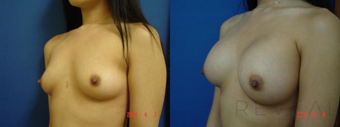 Before & After Breast Augmentation Case 180 View #2 View in San Jose, CA