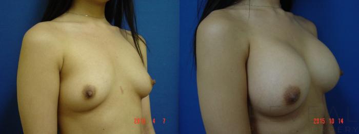 Before & After Breast Augmentation Case 180 View #3 View in San Jose, CA