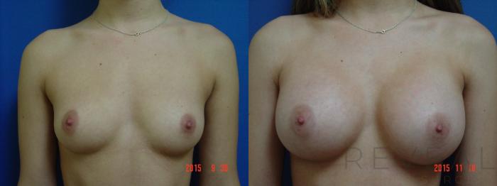 Before & After Breast Augmentation Case 185 View #1 View in San Jose, CA