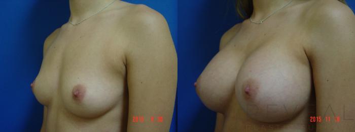 Before & After Breast Augmentation Case 185 View #2 View in San Jose, CA