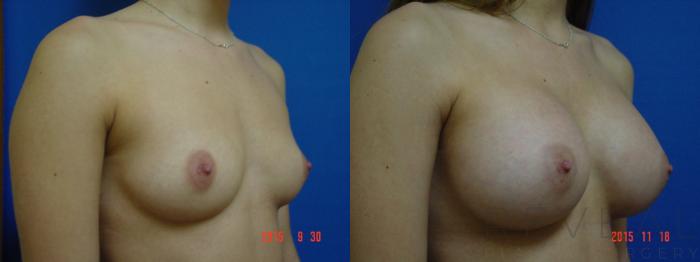 Before & After Breast Augmentation Case 185 View #3 View in San Jose, CA