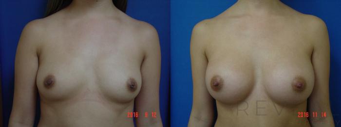 Before & After Breast Augmentation Case 203 View #1 View in San Jose, CA