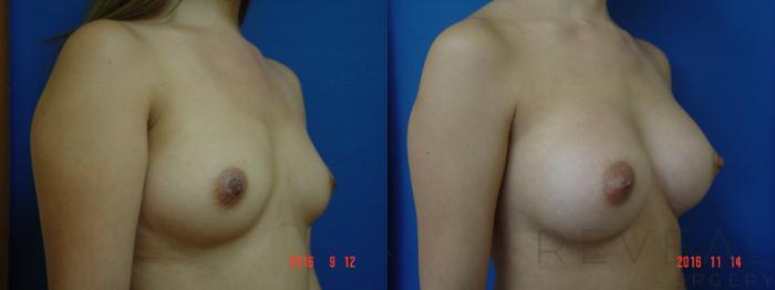 Before & After Breast Augmentation Case 203 View #2 View in San Jose, CA