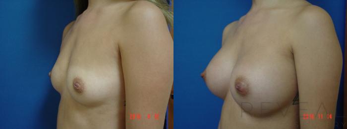 Before & After Breast Augmentation Case 203 View #3 View in San Jose, CA