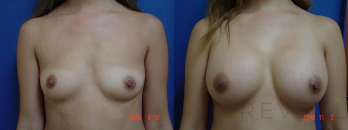 Before & After Breast Augmentation Case 204 View #1 View in San Jose, CA