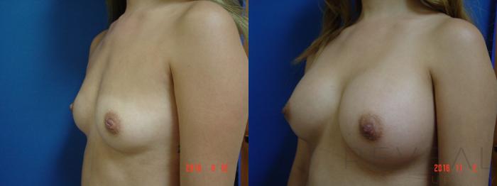 Before & After Breast Augmentation Case 204 View #2 View in San Jose, CA
